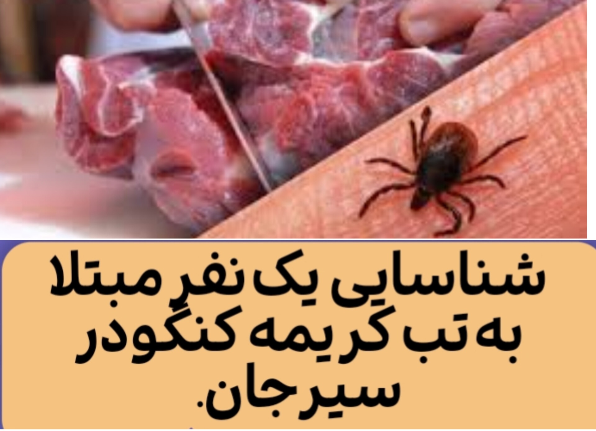 تصویر شناسایی  یک مورد مبتلا به تب کریمه کنگو در سیرجان*